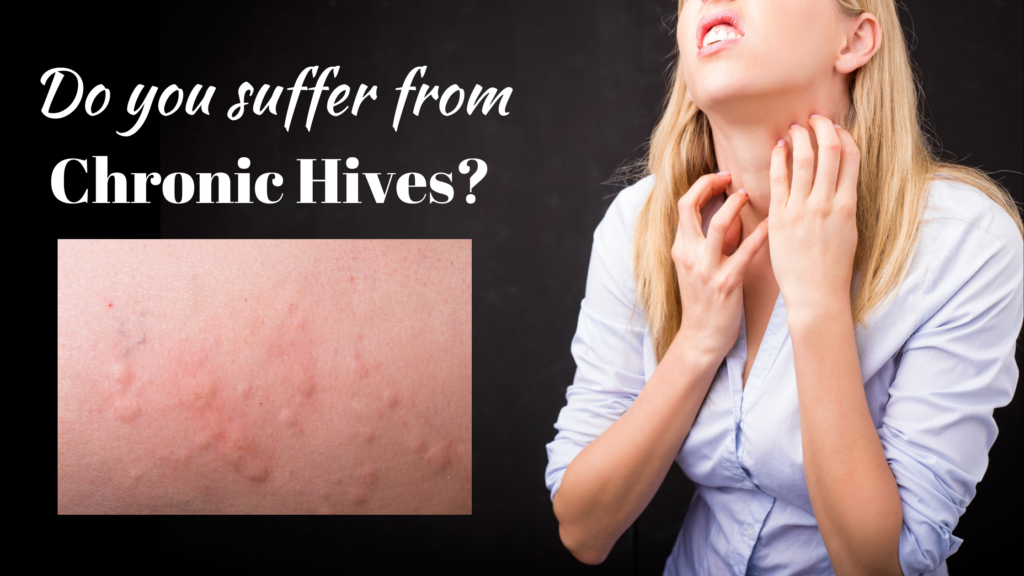 Are Chronic Hives Related To Autoimmune Thyroid Disease 